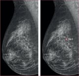 AI-supported breast cancer screening—new results suggest even higher accuracy