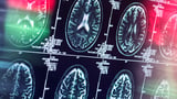 Researchers identify key driver behind soaring Alzheimer's cases… are YOU at risk?