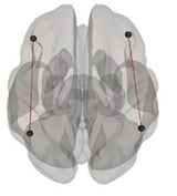 Brain stimulation can boost math learning in people with weaker neural connections