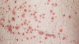 Europe Set to Approve New Immune Thrombocytopenia Therapy