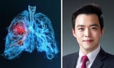 AI ‘Sybil’ predicts lung cancer risk from single LDCT scan