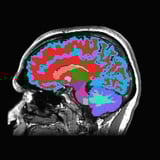 Scientists can tell how fast you're aging from a single brain scan