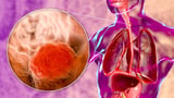 Progress in HER2-Positive Gastroesophageal Adenocarcinoma
