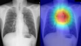 Achalasia diagnosis simplified to AI plus X-ray