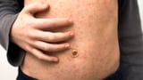 Measles hotspots: Two new cases that travelled on international and domestic flights detected in WA