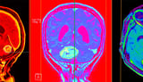 AI Distinguishes Glioblastoma From Look-Alike Cancers During Surgery
