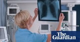 Allow more people in UK with lung cancer symptoms to self-refer for tests, say experts