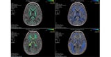 Myrtelle Announces Nature Medicine Publication of Interim Results from Its Phase 1/2 Clinical Trial of Investigational Gene Therapy rAAV-Olig001-ASPA for Canavan Disease
