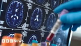 Breakthrough Alzheimer's drugs too pricey to be offered on NHS