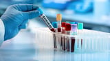 Proteomics bags US patent for endometriosis test