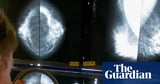 GPs’ breast cancer guidelines ‘miss’ 95% of women who will develop disease