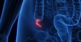 Appendix Cancer Has Quadrupled in Millennials