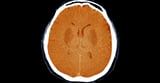 Unresponsive Brain-Damaged Patients May Have Some Awareness