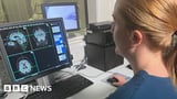 One million brain scans used to assess dementia risk