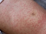 Commuters Alerted To Measles Exposure In August At Chicago Union Station, CDPH Says