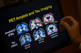 Blood tests for Alzheimer's may be coming to your doctor's office. Here's what to know