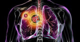 Health warning as Victorian-era lung disease cases continue to rise