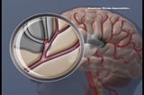 New medication may reduce chances of a second clot-caused stroke without bleeding risk