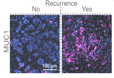 How Hypoxia Helps Cancer Spread