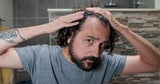 Breakthrough in baldness treatment as sugar found to stimulate hair growth