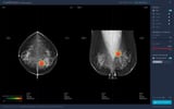 Lunit AI to read mammograms in Stockholm-wide breast cancer screening