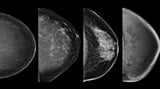 Fat cells may fuel aggressive breast cancers: Study