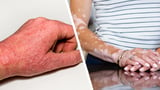 Do COVID-19 and Vaccination Impact Inflammatory Skin Disease Activity?