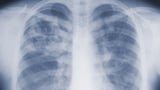 Study suggests the threat of mold-associated illnesses may be underappreciated
