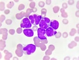 Researchers uncover new T cell attack mechanism against acute myeloid leukemia