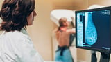 Artificial Intelligence Shows Promise in Detecting Missed Interval Breast Cancer on Screening Mammograms