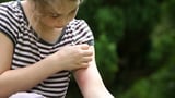 Why are some people's mosquito bites itchier than others'? New study hints at answer