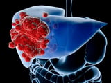 New OPTN policy will improve patient access to CEUS for liver cancer
