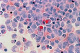 Incurable blood cancer tied to gene mutation in new lab model