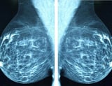 Breast cancer reshapes lymphatic vessels to support its spread