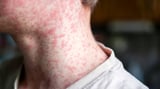 Kentucky’s measles outbreak has spread to Fayette County. Here’s what to know