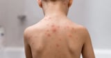 'Life saver' chickenpox vaccine to be offered to children in England for free