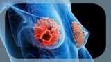 Adjuvant Abemaciclib Plus Endocrine Therapy Improves OS in High-Risk HR+/HER2– Breast Cancer
