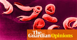 This new sickle cell treatment could be a gamechanger – if the NHS really starts to care about black people’s health | Tobi Oredein