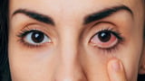 Half of adults suffer from dry eyes, but most never get help