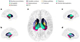 Large-scale study of brain volume finds genetic links to Parkinson's disease and ADHD