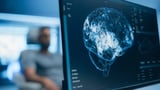 Mayo Clinic maps hidden biology of common brain tumors