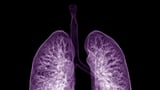 Insmed’s lung disease drug approved in the U.S.