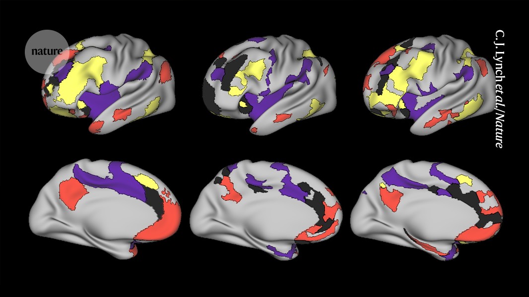 Found: a brain-wiring pattern linked to depression