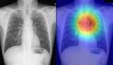Achalasia diagnosis simplified by AI plus chest X-ray