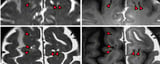 Scientists Mapped The Human Brain's Sewage System For The First Time