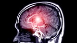 Environmental, Metabolic Factors Driving Global Rise in Stroke