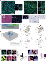 Traces of bacteria inside brain tumors may affect tumor behavior