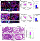 How inflammation drives prostate tumor formation