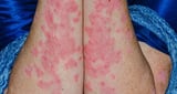 Moderate–to–severe plaque psoriasis – Modern management for GPs