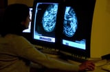 ‘Game-changing’ breast cancer pill capivasertib to be offered on NHS